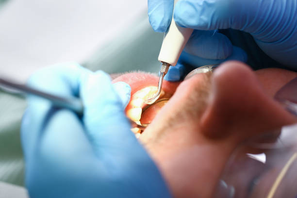 Best Emergency Dental Care for Broken or Chipped Teeth in Dupont, PA